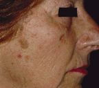 peeling a varie concentrazioni per trattare l'acne