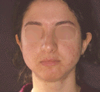 peeling a varie concentrazioni per trattare l'acne