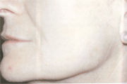 peeling e acido piruvico