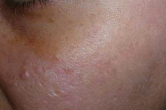 esiti da acne dopo il trattamento