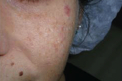 esiti da acne prima del trattamento